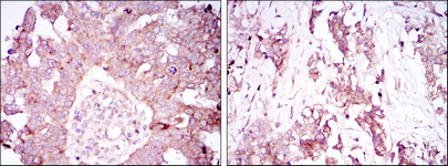 Immunohistochemistry analysis of paraffin-embedded ovarian cancer tissues (left) and lung cancer tissues (right) with DAB staining using Ataxin-1 Monoclonal Antibody