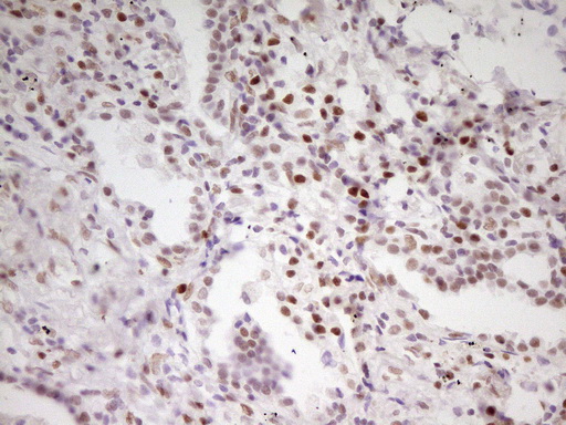 Immunohistochemical staining of paraffin-embedded Carcinoma of Human lung tissue using anti-MEF2D mouse monoclonal antibody