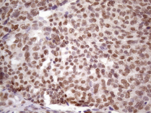 Immunohistochemical staining of paraffin-embedded Adenocarcinoma of Human ovary tissue using anti-IKBKE mouse monoclonal antibody