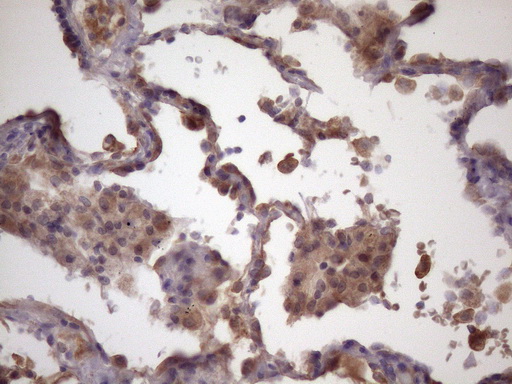 Immunohistochemical staining of paraffin-embedded Carcinoma of Human lung tissue using anti-FOXO4 mouse monoclonal antibody