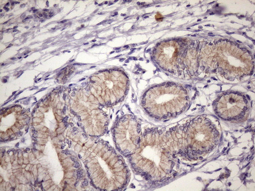 Immunohistochemical staining of paraffin-embedded Carcinoma of Human pancreas tissue using anti-FOXO4 mouse monoclonal antibody