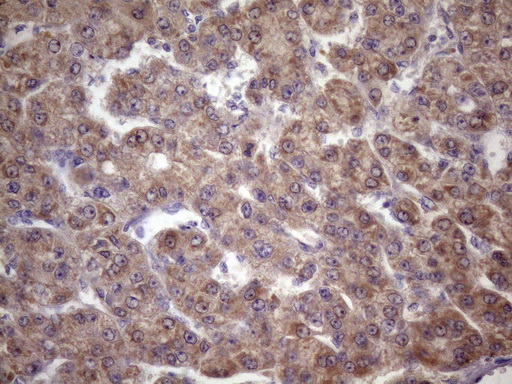 Immunohistochemical staining of paraffin-embedded Carcinoma of Human liver tissue using anti-FOXO4 mouse monoclonal antibody