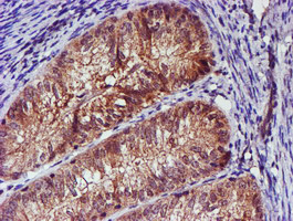 Immunohistochemical staining of paraffin-embedded Adenocarcinoma of Human endometrium tissue using anti-SMS mouse monoclonal antibody
