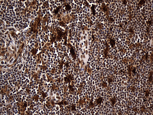 Immunohistochemical staining of paraffin-embedded Carcinoma of Human thyroid tissue using anti-RAD21 mouse monoclonal antibody