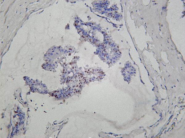 Human breast carcinoma was stained with Anti-Rad21 rabbit antibody