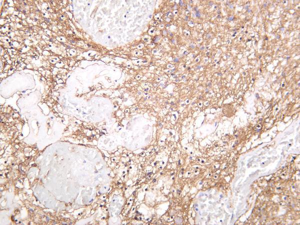 Human glioma was stained with anti-GAP43 rabbit antibody