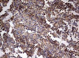 Immunohistochemical staining of paraffin-embedded Human lymphoma tissue using anti-OAS2 mouse monoclonal antibody