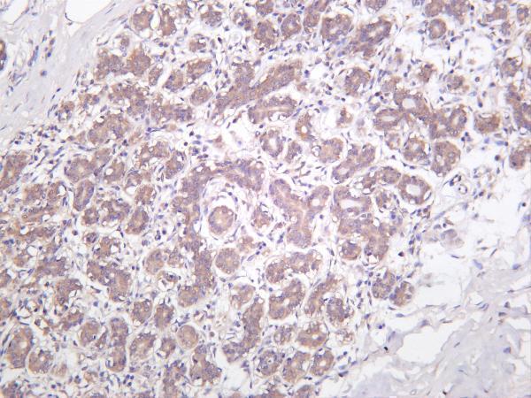 Human breast carcinoma was stained with anti-IKK α rabbit antibody
