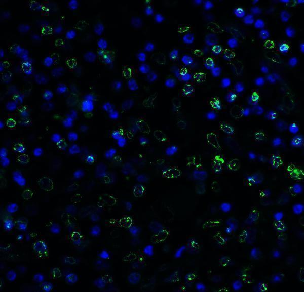 Immunofluorescence of TIGIT in human stomach carcinoma tissue using TIGIT Antibody at 5 μg/ml