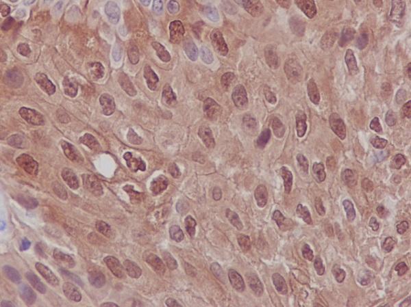 Immunohistochemical analysis of paraffin-embedded human bladder carcinoma, using S100P Antibody