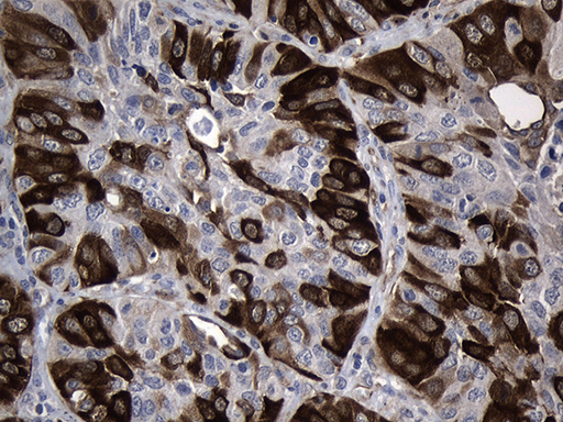 Immunohistochemical staining of paraffin-embedded Carcinoma of Human lung tissue using anti-RRM2 mouse monoclonal antibody