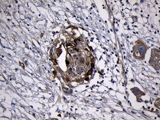 Immunohistochemical staining of paraffin-embedded Adenocarcinoma of Human ovary tissue using anti-RRM2 mouse monoclonal antibody