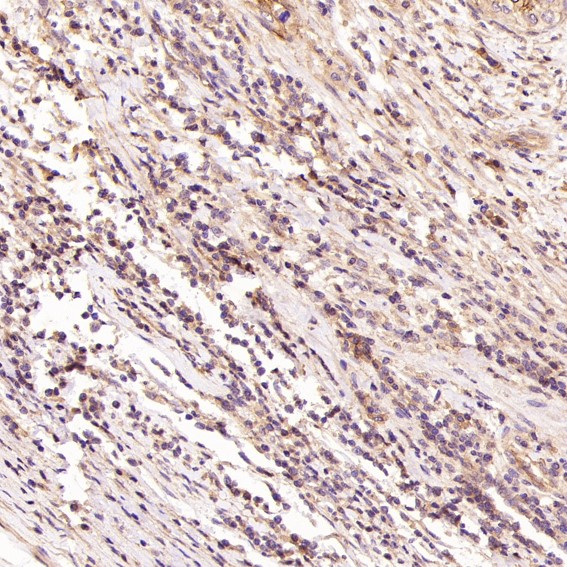 Immunohistochemical analysis of paraffin-embedded Human cervical cancer, using the Antibody at 1:100 dilution