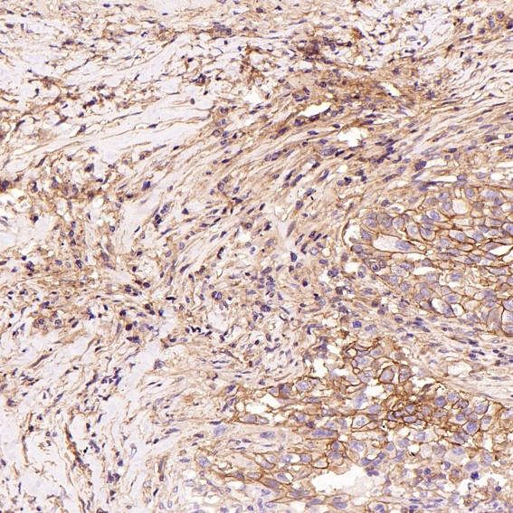 Immunohistochemical analysis of paraffin-embedded Human squamous cell carcinoma , using the Antibody at 1:100 dilution