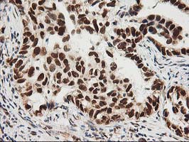 Immunohistochemical staining of paraffin-embedded Carcinoma of Human lung tissue using anti-ERCC4 mouse monoclonal antibody