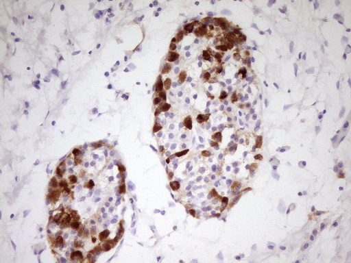 Immunohistochemical staining of paraffin-embedded Carcinoma of Human pancreas tissue using anti-APOH mouse monoclonal antibody