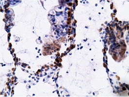 Immunohistochemical staining of paraffin-embedded Carcinoma of Human lung tissue using anti-EPHX2 mouse monoclonal antibody