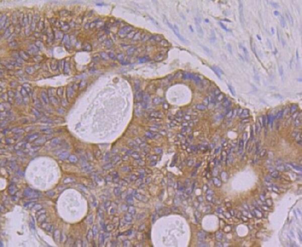 Immunohistochemical analysis of paraffin-embedded human colon carcinoma tissue using anti-PON2 antibody