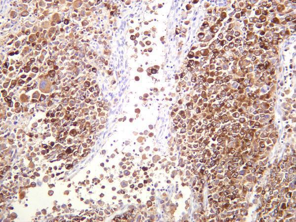 Human melanoma was stained with anti-MelanA rabbit antibody