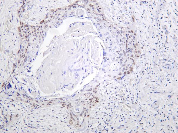 Human cervical carcinoma was stained with anti-c-Jun rabbit antibody