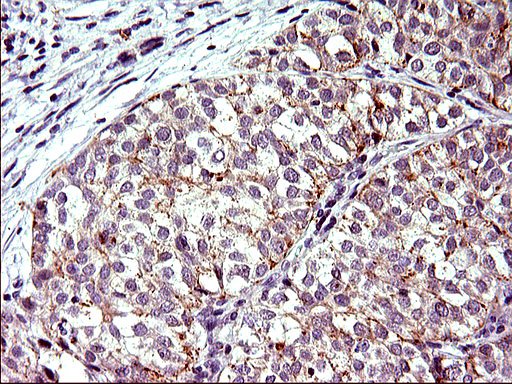 Immunohistochemical staining of paraffin-embedded Carcinoma of Human liver tissue using anti-TOLLIP mouse monoclonal antibody