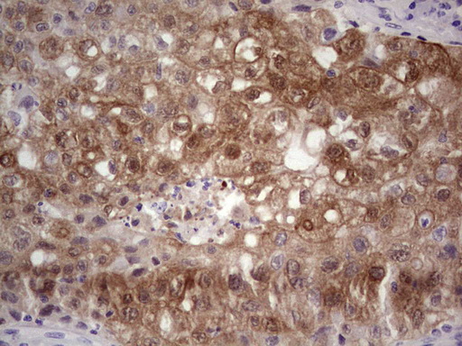 Immunohistochemical staining of paraffin-embedded Carcinoma of Human lung tissue using anti-S100A6 mouse monoclonal antibody