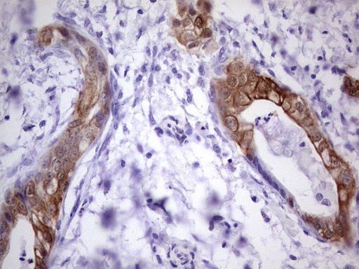 Immunohistochemical staining of paraffin-embedded Carcinoma of Human pancreas tissue using anti-S100A6 mouse monoclonal antibody
