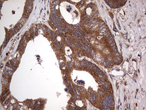 Immunohistochemical staining of paraffin-embedded Adenocarcinoma of Human colon tissue using anti-ARAF mouse monoclonal antibody