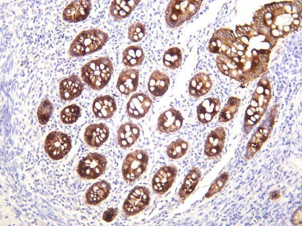 Human colon carcinoma was stained with anti-Cytokeratin 19 rabbit antibody