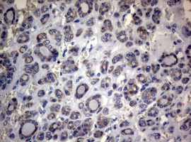 Immunohistochemical staining of paraffin-embedded Carcinoma of Human thyroid tissue using anti-MFN1 mouse monoclonal antibody