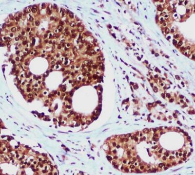 Immunohistochemical analysis of paraffin-embedded Prostate Cancer using Rad23B mouse mAb (1/100 dilution)