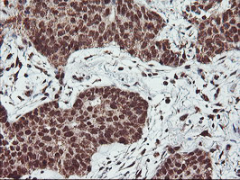 Immunohistochemical staining of paraffin-embedded Carcinoma of Human lung tissue using anti-PDE4B mouse monoclonal antibody