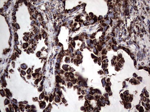 Immunohistochemical staining of paraffin-embedded Carcinoma of Human lung tissue using anti-PIK3CD mouse monoclonal antibody