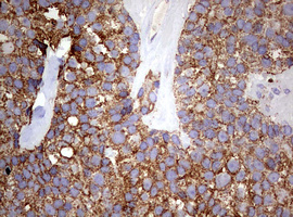 Immunohistochemical staining of paraffin-embedded Adenocarcinoma of Human breast tissue using anti-PIK3CD mouse monoclonal antibody
