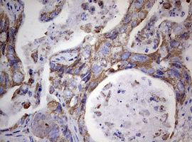 Immunohistochemical staining of paraffin-embedded Adenocarcinoma of Human colon tissue using anti-PIK3CD mouse monoclonal antibody