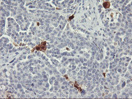 Immunohistochemical staining of paraffin-embedded Adenocarcinoma of Human ovary tissue using anti-SDS mouse monoclonal antibody
