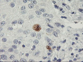 Immunohistochemical staining of paraffin-embedded Carcinoma of Human bladder tissue using anti-SDS mouse monoclonal antibody