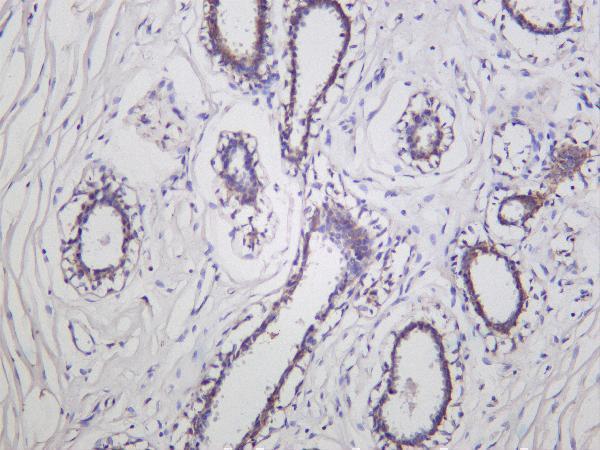 Human ductal breast carcinoma was stained with Anti-EEA1 rabbit antibody