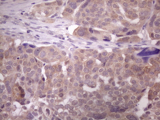 Immunohistochemical staining of paraffin-embedded Adenocarcinoma of Human ovary tissue using anti-DMRT1 mouse monoclonal antibody