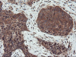 Immunohistochemical staining of paraffin-embedded Carcinoma of Human lung tissue using anti-SENP2 mouse monoclonal antibody