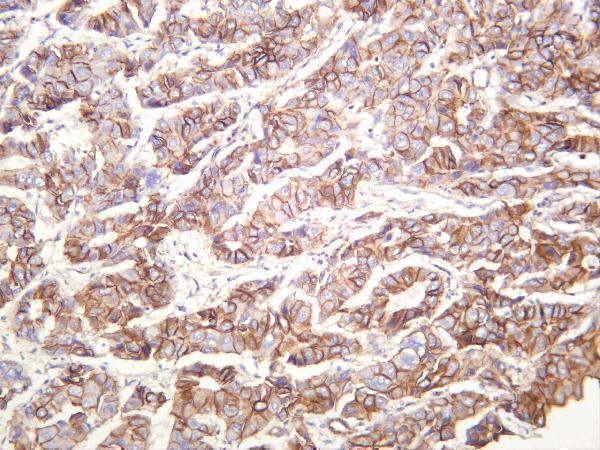 Human cervical squamous carcinoma was stained with anti-Catenin δ-1 rabbit antibody
