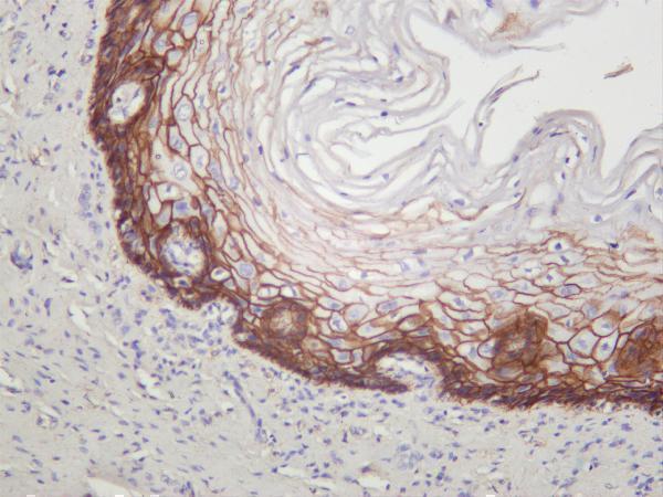Human hepatocellular carcinoma was stained with anti-Catenin δ-1 rabbit antibody