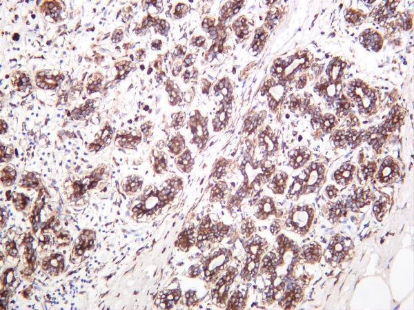 Human breast carcinoma was stained with anti-PDI rabbit antibody