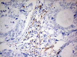Immunohistochemical staining of paraffin-embedded Adenocarcinoma of Human breast tissue using anti-MSR1 mouse monoclonal antibody