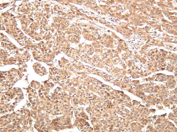 Human hepatocellular carcinoma was stained with anti-ATP-Citrate Lyase rabbit antibody