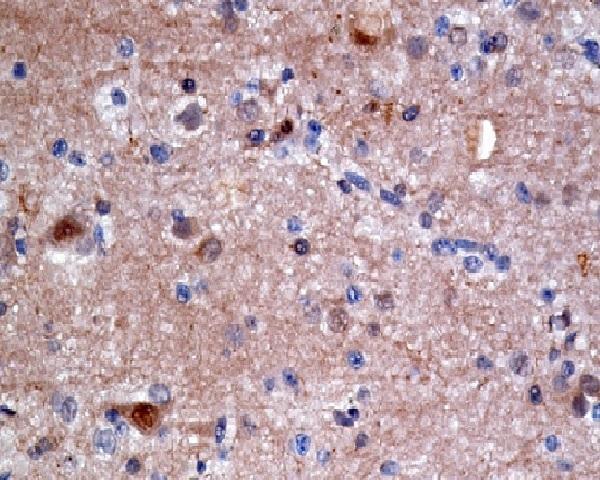 Immunohistochemical analysis of paraffin-embedded human brain carcinoma, using ATP citrate lyase Antibody 