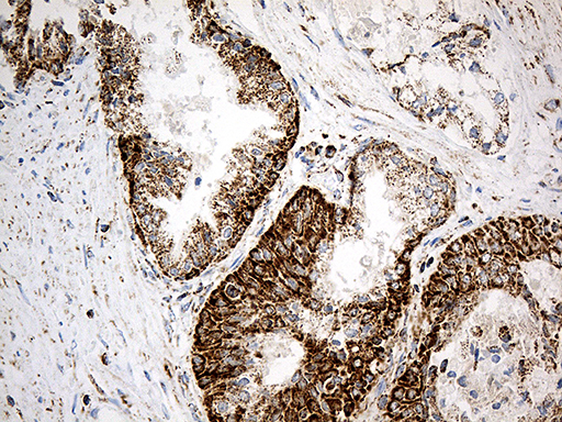 Immunohistochemical staining of paraffin-embedded Carcinoma of Human prostate tissue using anti-ACADM mouse monoclonal antibody