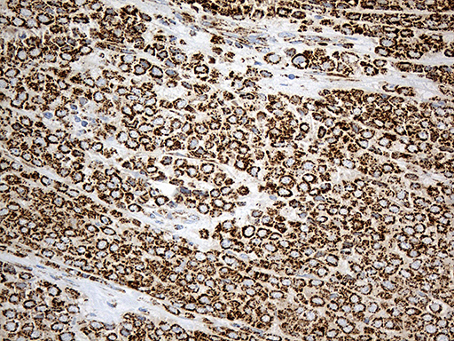Immunohistochemical staining of paraffin-embedded Adenocarcinoma of Human breast tissue tissue using anti-ACADM mouse monoclonal antibody
