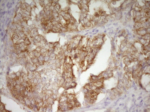 Immunohistochemical staining of paraffin-embedded Adenocarcinoma of Human endometrium tissue using anti-DVL2 mouse monoclonal antibody