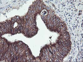 Immunohistochemical staining of paraffin-embedded Carcinoma of Human pancreas tissue using anti-TRAP1 mouse monoclonal antibody